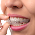 Invisalign