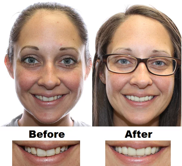 Dental before and after photos of dental patient at Northcutt Dental