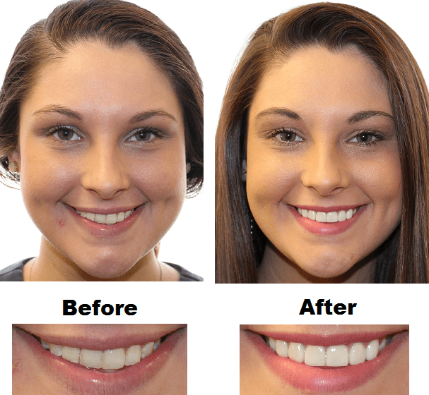 Dental before and after photos of dental patient at Northcutt Dental